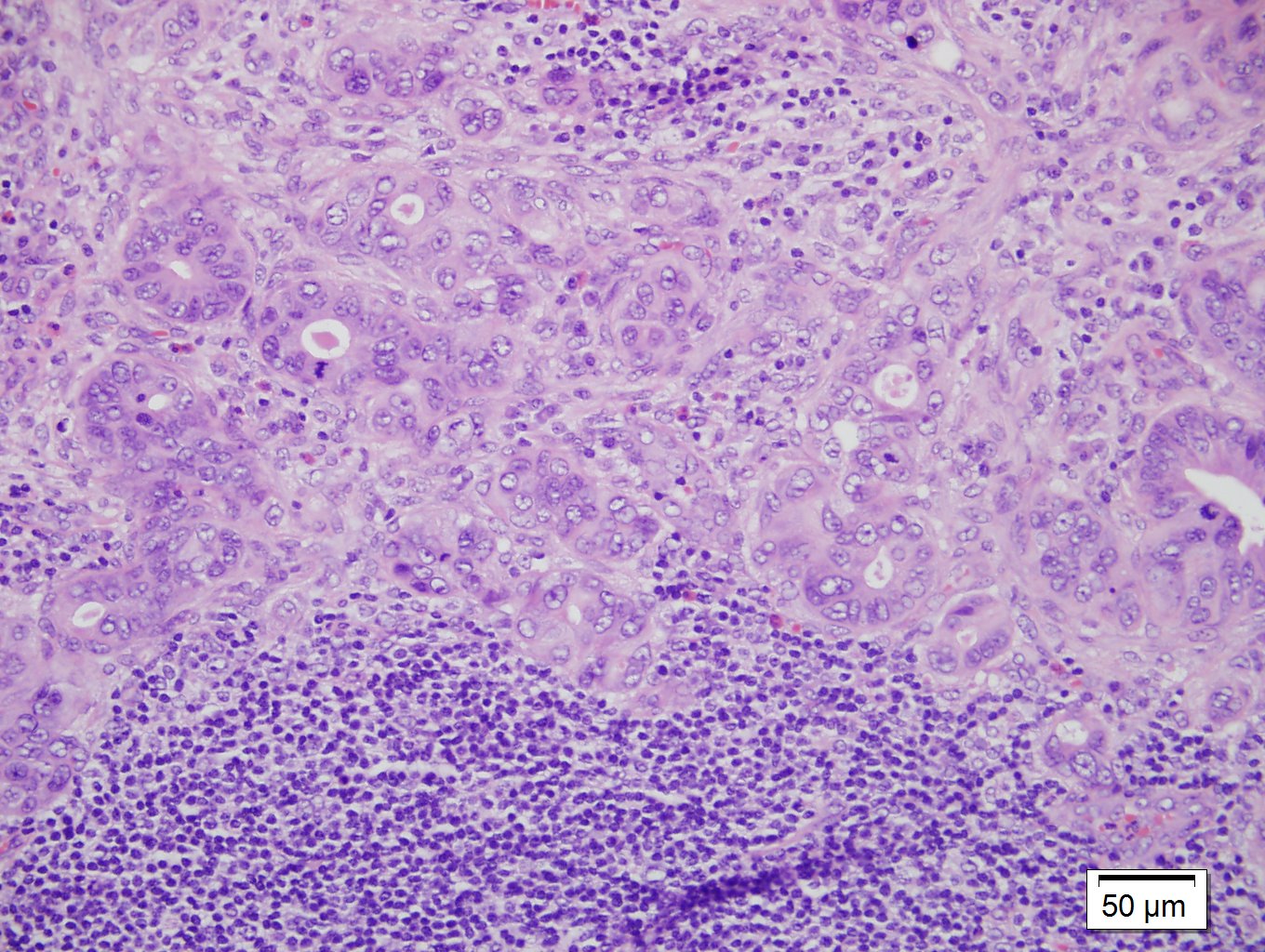 virchow-s-node-with-adenocarcinoma-high-power-picture